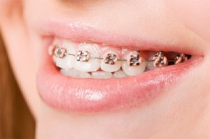 Metal-Braces-Image-4