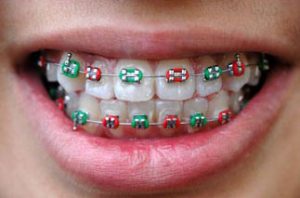 colored-metal-braces-in-Dubai