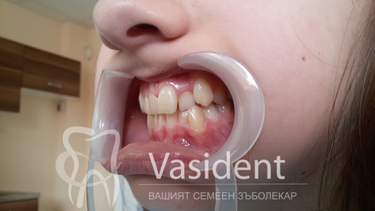 Преди лечението