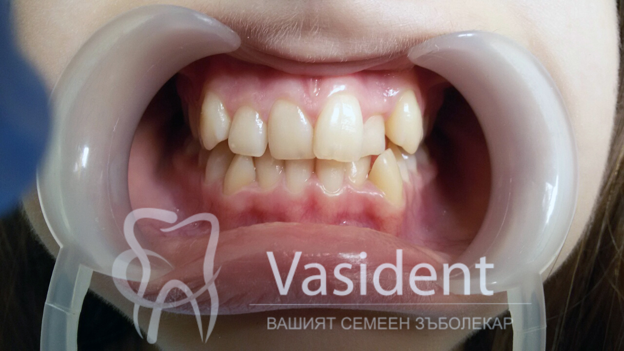 Преди лечението
